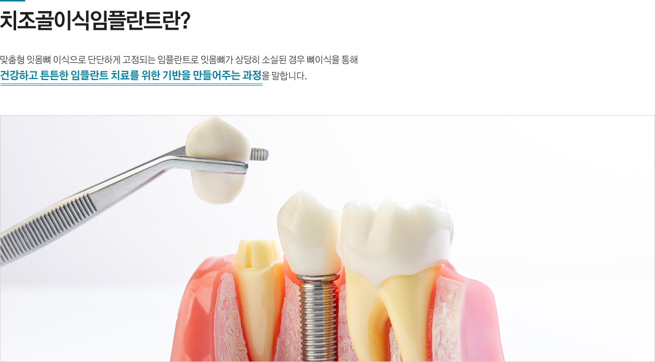 치조골이식임플란트란?
맞춤형 잇몸뼈 이식으로 단단하게 고정되는 임플란트로 잇몸뼈가 상당히 소실된 경우 뼈이식을 통해 건강하고 튼튼한 임플란트 치료를 위한 기반을 만들어주는 과정을 말합니다.