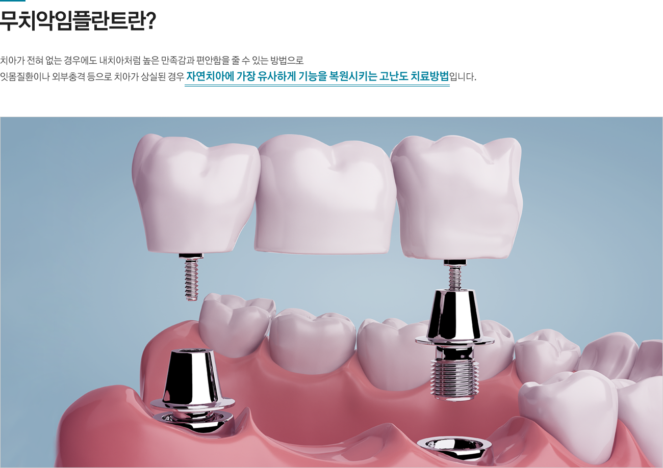 무치악임플란트란?
치아가 전혀 없는 경우에도 내치아처럼 높은 만족감과 편안함을 줄 수 있는 방법으로 잇몸질환이나 외부충격 등으로 치아가 상실된 경우 자연치아에 가장 유사하게 기능을 복원시키는 고난도 치료방법입니다.