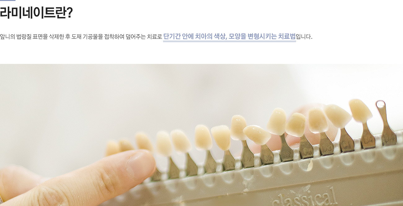 라미네이트란?
앞니의 법랑질 표면을 삭제한 후 도재 기공물을 접착하여 덮어주는 치료로 단기간 안에 치아의 색상, 모양을 변형시키는 치료법입니다.