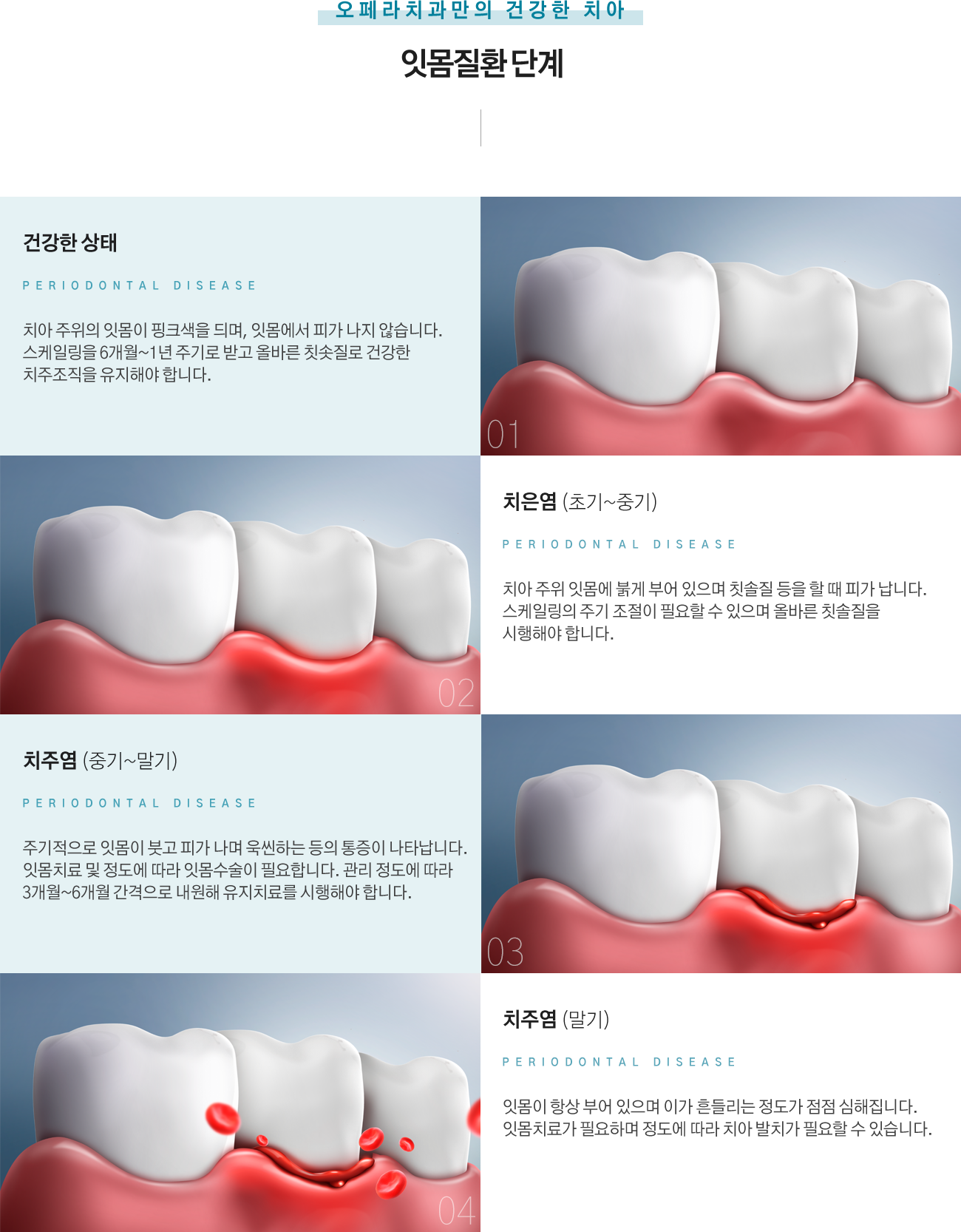 잇몸질환 단계
건강한 상태 : 치아 주위의 잇몸이 핑크색을 듸며, 잇몸에서 피가 나지 않습니다. 스케일링을 6개월~1년 주기로 받고 올바른 칫솟질로 건강한 치주조직을 유지해야 합니다.
치은염 (초기~중기) : 치아 주위 잇몸에 붉게 부어 있으며 칫솔질 등을 할 때 피가 납니다. 스케일링의 주기 조절이 필요할 수 있으며 올바른 칫솔질을 시행해야 합니다.
치주염 (중기~말기) : 주기적으로 잇몸이 붓고 피가 나며 욱씬하는 등의 통증이 나타납니다. 잇몸치료 및 정도에 따라 잇몸수술이 필요합니다. 관리 정도에 따라 3개월~6개월 간격으로 내원해 유지치료를 시행해야 합니다.
치주염 (말기) : 잇몸이 항상 부어 있으며 이가 흔들리는 정도가 점점 심해집니다. 잇몸치료가 필요하며 정도에 따라 치아 발치가 필요할 수 있습니다.