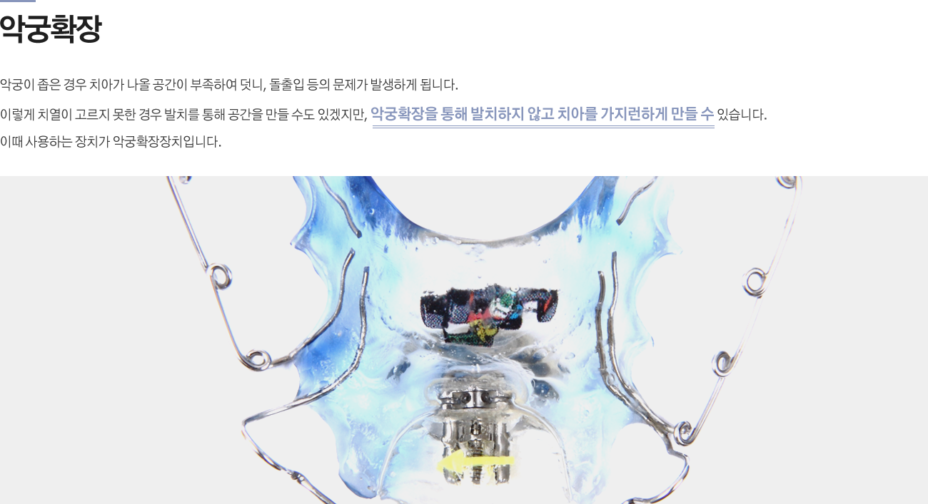 악궁확장 
			악궁이 좁은 경우 치아가 나올 공간이 부족하여 덧니, 돌출입 등의 문제가 발생하게 됩니다. 이렇게 치열이 고르지 못한 경우 발치를 통해 공간을 만들 수도 있겠지만, 악궁확장을 통해 발치하지 않고 치아를 가지런하게 만들 수 있습니다.